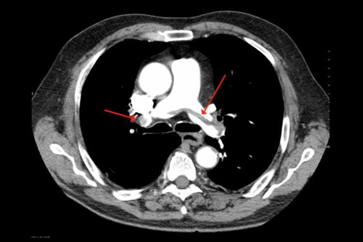 Computer Tomographic Pulmonary Angiography (CTPA) Pulmonary Embolism (PE) - DVT to PE, Symptoms, Treatment & Causes