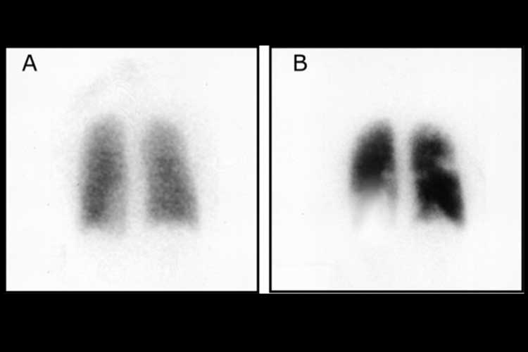 Ventilation perfusion scan Pulmonary Embolism (PE) - DVT to PE, Symptoms, Treatment & Causes