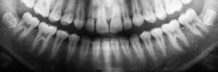 Mouth assessment x-ray of teeth | Image