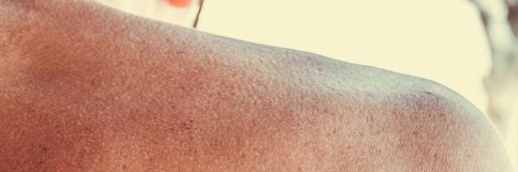Skin rash on the back of someones shoulder | Image