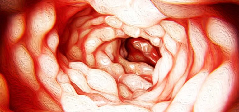 Image for Crohn’s Disease