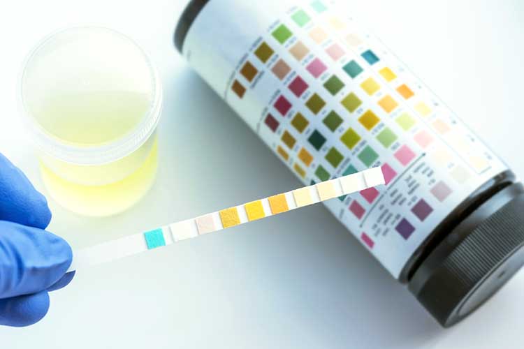 urine dipstick test