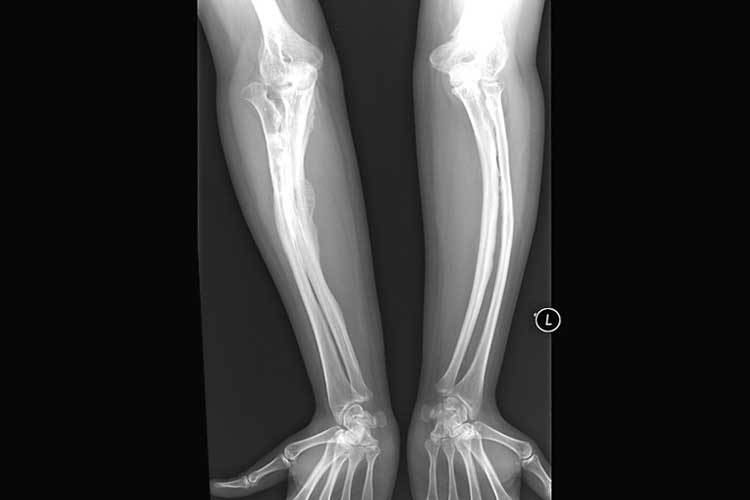 Osteogenesis Imperfecta Type V in Adult